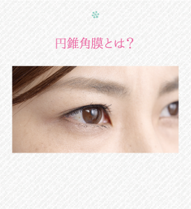 円錐角膜とは？